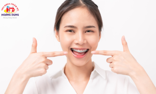 Những Điều Nên Biết Về Niềng Răng Mắc Cài