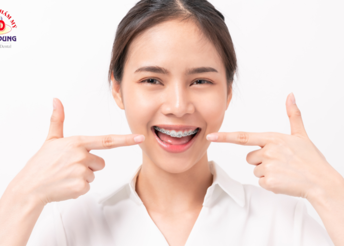 Những Điều Nên Biết Về Niềng Răng Mắc Cài