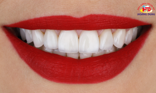 Bọc răng sứ có đau không? Bọc răng sứ ở đâu tại Nghệ An?