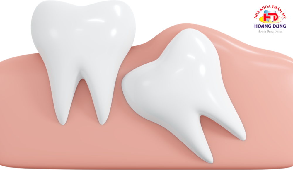 Nhổ Răng Khôn Số 8 Tại Nha Khoa Hoàng Dung