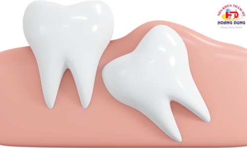 Nhổ Răng Khôn Số 8 Tại Nha Khoa Hoàng Dung