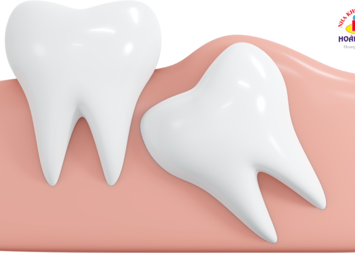 Nhổ Răng Khôn Số 8 Tại Nha Khoa Hoàng Dung